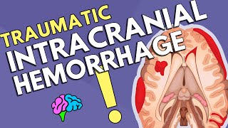 Intracranial Hemorrhage [upl. by Havelock]