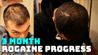 3 Month Rogaine Results and Progress Minoxidil [upl. by Faden]