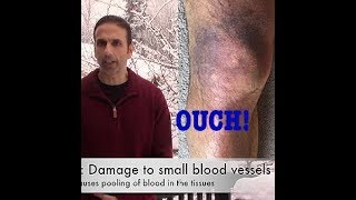 Hematoma leg bruising and swelling [upl. by Hatnamas]