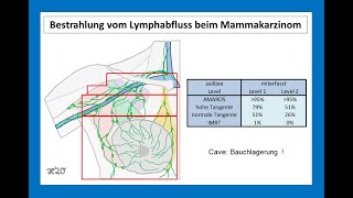 Bestrahlung vom Lymphabflussgebiet beim Mammakarzinom  Strahlentherapie Prof Hilke Vorwerk [upl. by Pedersen439]