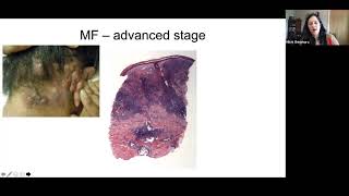 Pathology Grand Rounds  Cutaneous TCell Lymphoma  Dr Michi Shinohara [upl. by Allebara]