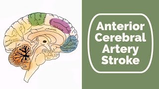 Anterior Cerebral Artery Stroke [upl. by Nathanil]