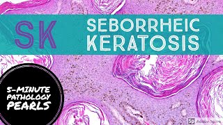 Seborrheic Keratosis 5Minute Pathology Pearls [upl. by Annavoeg]