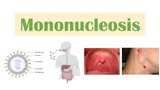 Infectious Mononucleosis Mono  EpsteinBarr Virus Transmission Symptoms Diagnosis Treatment [upl. by Giorgi]