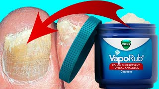 How To Use Vicks To Treat amp Cure Toenail Fungus  FAST EASY REMEDY [upl. by Arbmat]