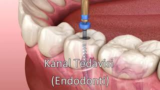 Kanal Tedavisi  Endodonti [upl. by Trebmal739]