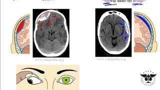 Best Stroke Recovery Hand Exercises  Stage 1 [upl. by Flory]