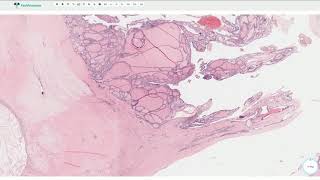 What is Familial Adenomatous Polyposis FAP [upl. by Aihsar380]