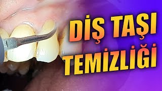 Diş Taşı Temizliği ve Kök Yüzeyi Düzleştirmesi [upl. by Schnurr]