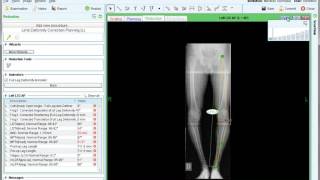 Weil Osteotomy Performed by Dr Paul Steinke [upl. by Ssur]