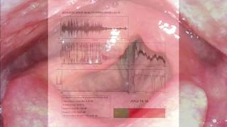 Airway Devices 01 Direct Laryngoscopy [upl. by Arreit]