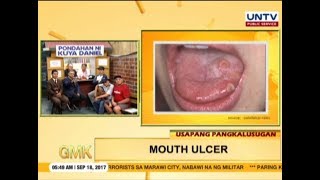 Mouth Ulcer  Canker Sores  Usapang Pangkalusugan [upl. by Yelyak]