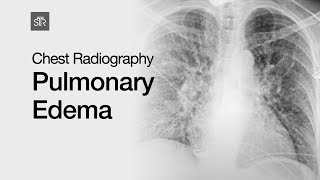 Chest Radiography Pulmonary Edema [upl. by Acireit443]