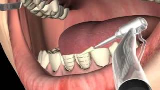 What are Dental Veneers [upl. by Cordeelia]