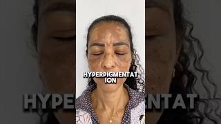 Facemask For Hyperpigmentation  Mridul Madhok [upl. by Nylcoj]