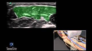 How To Ultrasound Guided Median and Ulnar Nerve Block 3D Video [upl. by Cinnamon]