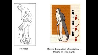 Fauchage et Steppage  Neurologie [upl. by Sollie642]