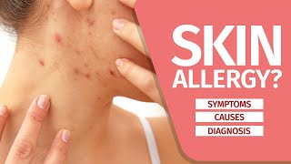 What is Skin Allergy Symptoms Causes Diagnosis and Triggers [upl. by Hildagarde]