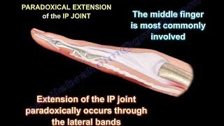 Lumbrical Plus Finger  Everything You Need To Know  Dr Nabil Ebraheim [upl. by Leynwad]