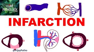 INFARCTION Causes Types Morphology [upl. by Dosi]