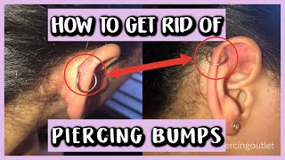 HOW TO GET RID OF PIERCING BUMPS [upl. by Riccio98]