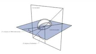 Anteversion and inclination of an acetabular cup [upl. by Ineslta]