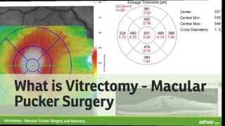 Vitrectomy  Macular Pucker Surgery and Recovery [upl. by Alarick]