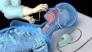 Nasotracheal suctioning NTS  3D animation [upl. by Hurleigh765]