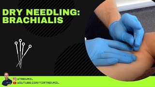 Dry Needling Brachialis [upl. by Aubry]