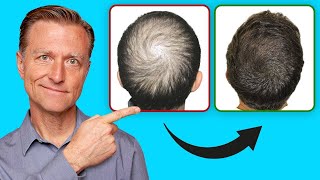 These Treatments REVERSE Thyroid Hair Loss [upl. by Mcgruter]