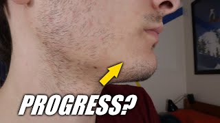 Getting a Thicker Beard Using a Derma Roller Month 3 [upl. by Ytiak762]