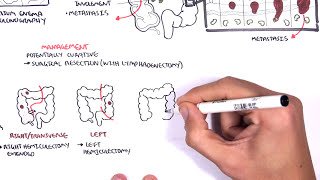 Colorectal Cancer  Overview [upl. by Roinuj328]