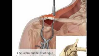 LARS Ligament ACJmov [upl. by Elatnahs368]