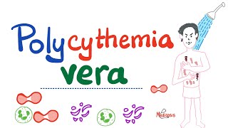 Polycythemia Vera PV  Myeloproliferative Neoplasm MPN  Erythrocytosis  Hematology [upl. by Kern737]