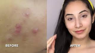 How to use Phitkari Alum to Treat Acne  Pigmentation and for Permanent Hair Removal  Life Hacks [upl. by Pohsib210]