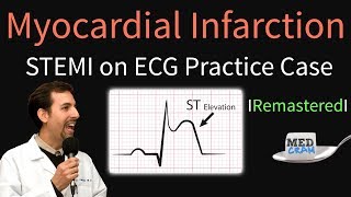 Myocardial Infarction  STEMI on ECG  Practice EKG [upl. by Aiceila]