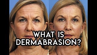 Dermabrasion [upl. by Stevena]