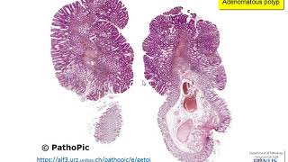 Nontoxic Multinodular goiter [upl. by Aikrehs]