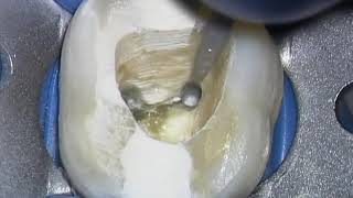 Broken Instrument Removal  Animation amp Clinical Op Sequence Advanced Endodontics [upl. by Irene868]