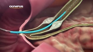 QuickPlaceV Biliary Stent [upl. by Culbertson]