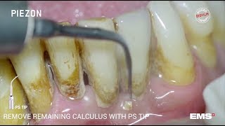 Guided Biofilm Therapy Step 06 Calculus removal with PIEZON® and the PS instrument [upl. by Dahsraf3]