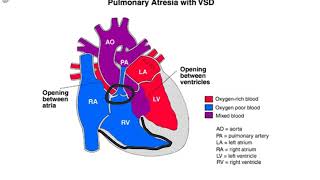 Pulmonary Atresia [upl. by Eramal]