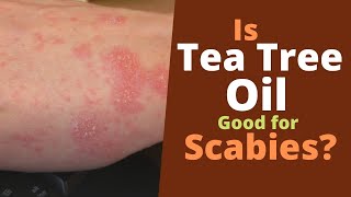 Tea Tree Oil for Scabies Does It Kill Scabies [upl. by Atnauqal]