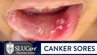 Determining Causes amp Treatment for Canker Sores  SLUCare Otolaryngology [upl. by Elbertine]