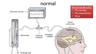 Hipertensión Endocraneana  FISIOPATOLOGIA  GRUPO ATLAS [upl. by Og]