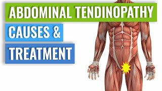 Abdominal Tendinopathy  Causes and Treatment Including Exercises [upl. by Hesper]