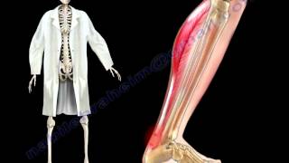 Achilles Tendon Stress amp Strain  Everything You Need To Know  Dr Nabil Ebraheim [upl. by Shayne174]