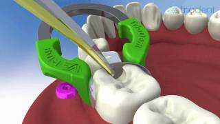 Triodent V3 Sectional Matrix System Animation VoiceOver [upl. by Herb]