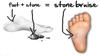 Stone Bruise Foot Pain HOME Treatment [upl. by Cosimo]