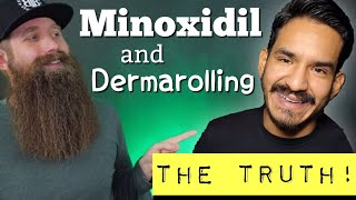 Minoxidil amp Dermarolling  The TRUTH [upl. by Namie]